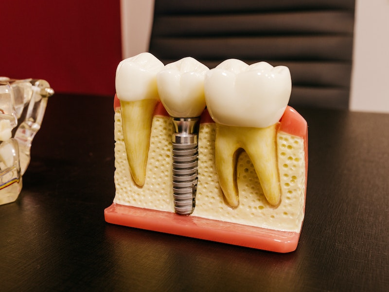 5 Surefire Signs You May Need Dental Implants